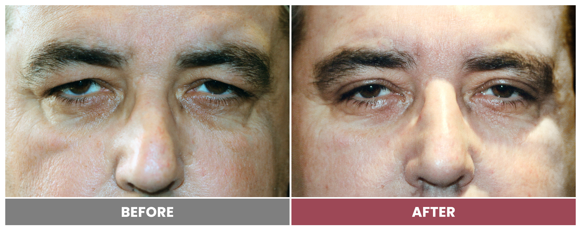 Upper Blepharoplasty - Case 101